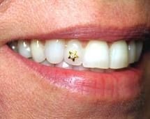 Dental Jewellery Dolphin 22kt Gold