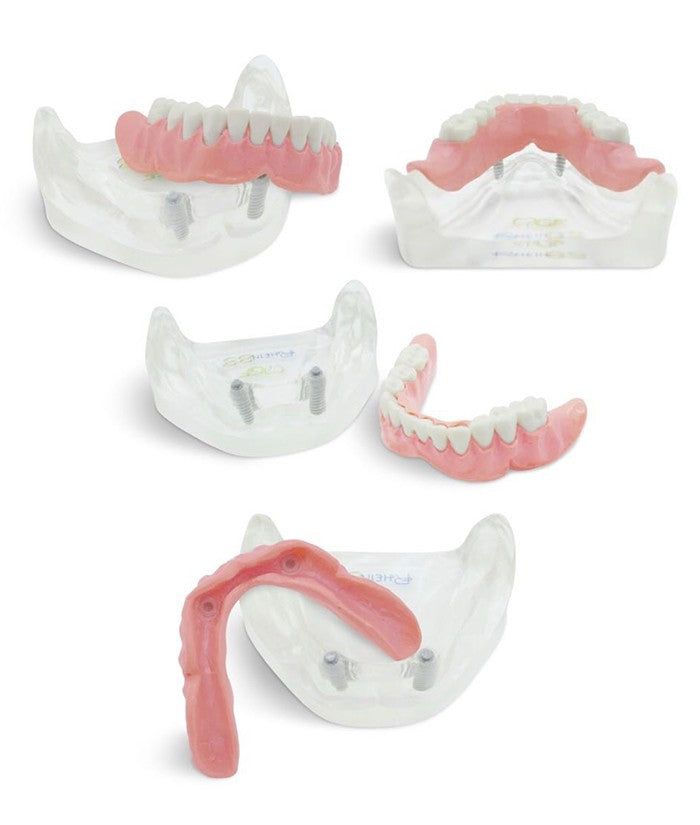 Dental Model for Overdenture with Implants