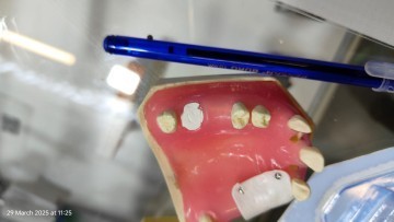 Post Extraction Immediate Implant Model