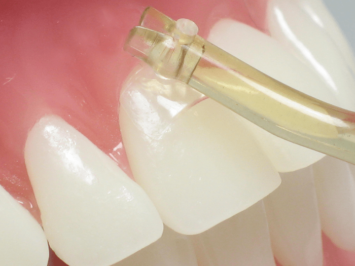 iMatrices Dental Matrices for Class 5 Filling