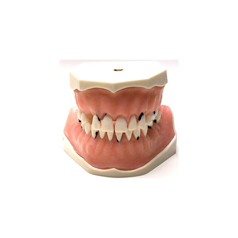 Parodonthology Jaw with diffusely carious teeth