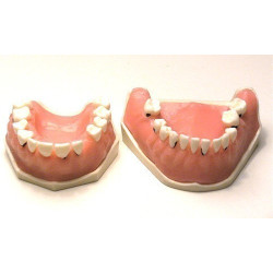 Parodonthology Jaw with diffusely carious teeth