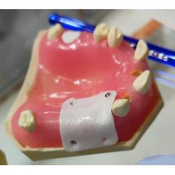 Post Extraction Immediate Implant Model