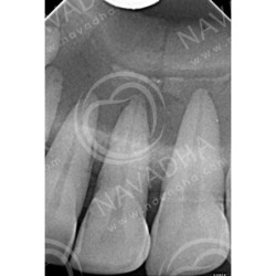 Dental Vice pair for Extracted Tooth & Magnetic or Screw in type Vice Pair
