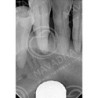 Dental Vice pair for Extracted Tooth & Magnetic or Screw in type Vice Pair