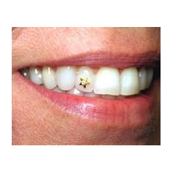 Dental Jewellery - Heart - 22kt gold