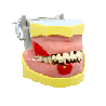 Articulated periodontia Dentoform with inflammation