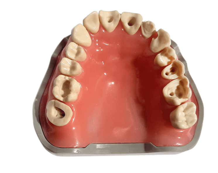 Prosthetic Dental Model with Prepared Teeth (Upper)