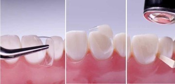 Dental Transparent Strip Crowns Posterior