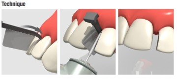 Directa FenderWedge Prep Dental Wedge
