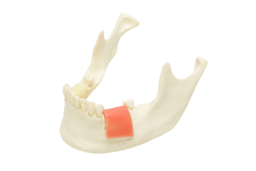 Model for Implant Placement with Replaceable Bone Blocks