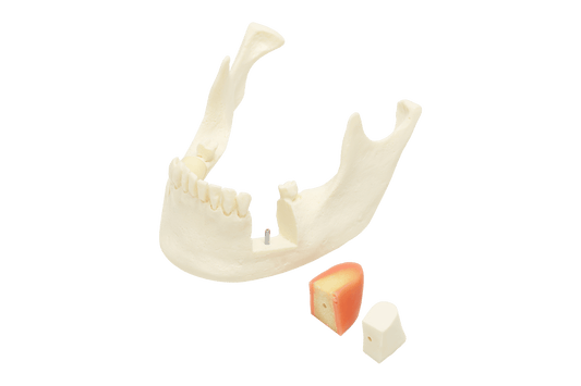 Model for Implant Placement with Replaceable Bone Blocks