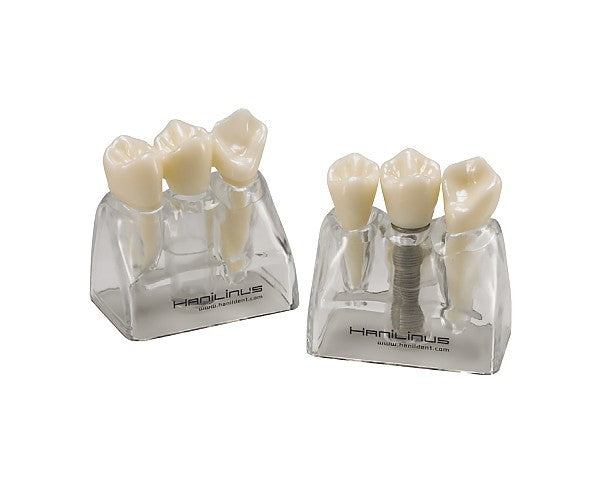 Implant Tooth Model 3000