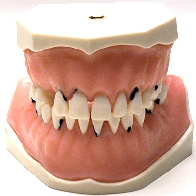 Parodonthology Jaw with Diffusely Carious Teeth