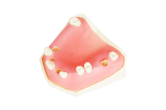 Post Extraction Immediate Implant Model