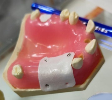 Post Extraction Immediate Implant Model
