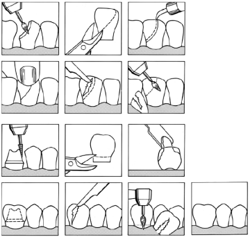 Dental Transparent Strip Crowns Posterior