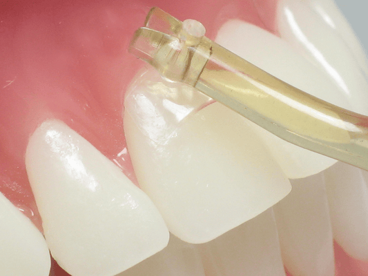 iMatrices Dental Matrices for Class 5 Filling